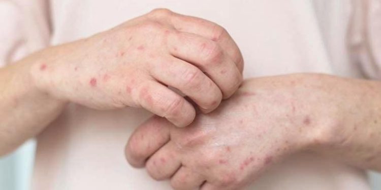 Cilt sıhhati sorunu: Egzama ve tedavi formülleri