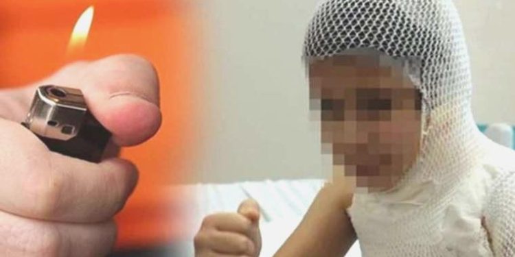 Görüntüden etkilenerek kolonyayla kendini yakmıştı: 9 yaşındaki çocuk ameliyat edildi
