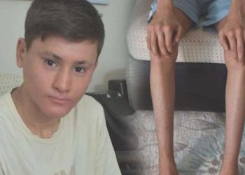 Hastalığı yüzünden gündüzleri konuttan çıkamıyor: ‘Balık pulu’ hastası Kayra’nın bakım parası kesildi