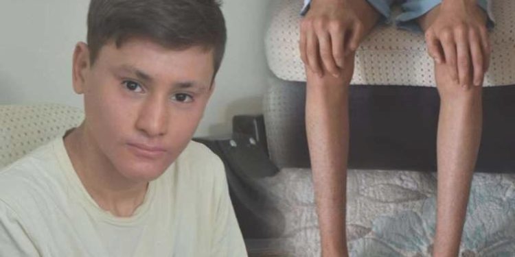 Hastalığı yüzünden gündüzleri konuttan çıkamıyor: ‘Balık pulu’ hastası Kayra’nın bakım parası kesildi