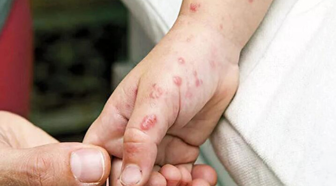 Ankara’da maymun çiçeği iddiası!